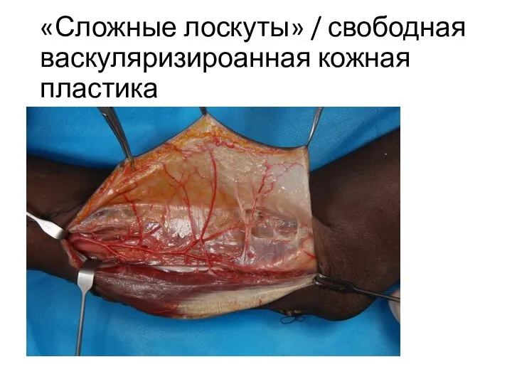 «Сложные лоскуты» / свободная васкуляризироанная кожная пластика