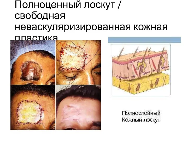 Полноценный лоскут / свободная неваскуляризированная кожная пластика