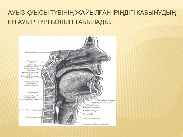 АУЫЗ ҚУЫСЫ ТҮБІНІҢ ЖАЙЫЛҒАН ІРІҢДІГІ КАБЫНУДЫҢ ЕҢ АУЫР ТҮРІ БОЛЫП ТАБЫЛАДЫ.