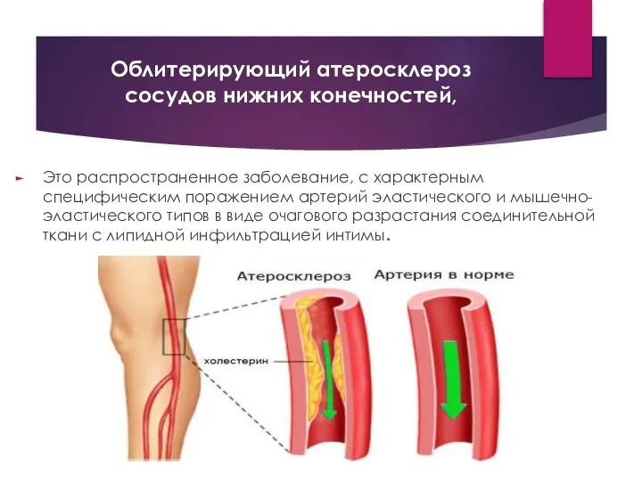 Облитерирующий атеросклероз сосудов нижних конечностей, Это распространенное заболевание, с характерным специфическим поражением