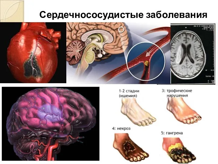 Сердечнососудистые заболевания