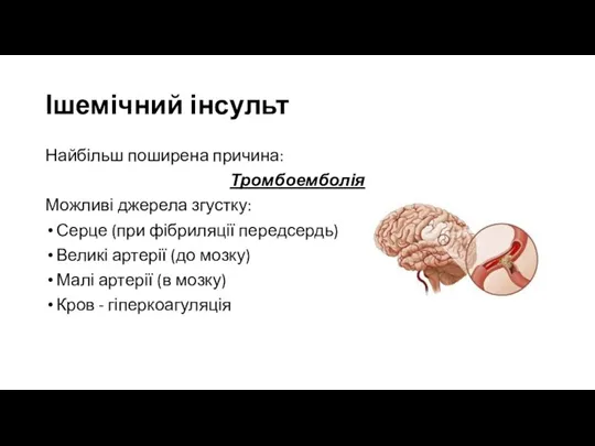 Ішемічний інсульт Найбільш поширена причина: Тромбоемболія Можливі джерела згустку: Серце (при фібриляції