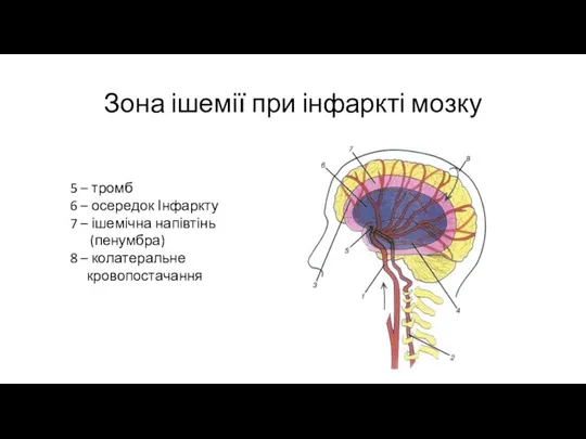 Зона ішемії при інфаркті мозку 5 – тромб 6 – осередок Інфаркту