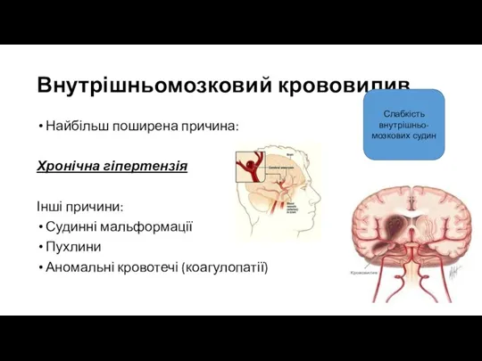 Внутрішньомозковий крововилив Найбільш поширена причина: Хронічна гіпертензія Інші причини: Судинні мальформації Пухлини