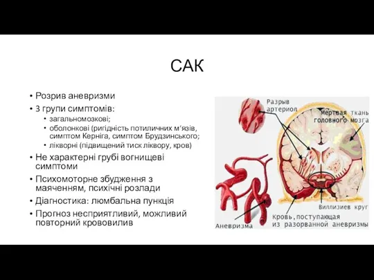 САК Розрив аневризми 3 групи симптомів: загальномозкові; оболонкові (ригідність потиличних м’язів, симптом