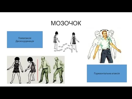 МОЗОЧОК Геміатаксія Дискоординація Горизонтальна атаксія