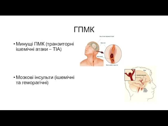ГПМК Минущі ПМК (транзиторні ішемічні атаки – ТІА) Мозкові інсульти (ішемічні та геморагічні)