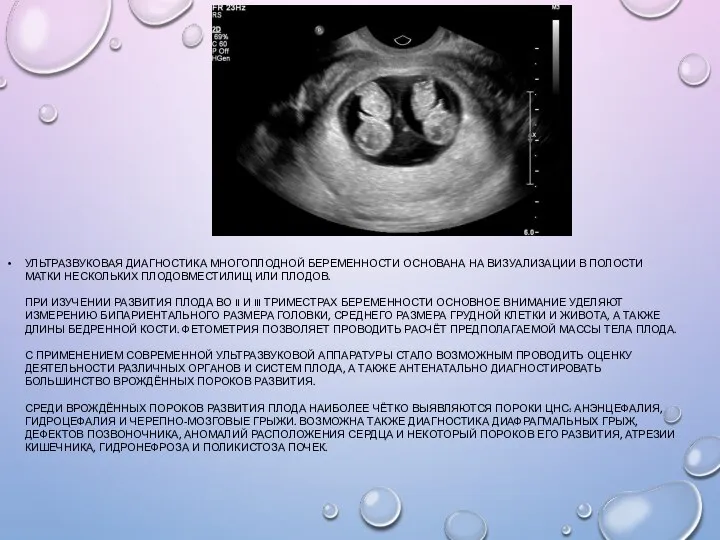 УЛЬТРАЗВУКОВАЯ ДИАГНОСТИКА МНОГОПЛОДНОЙ БЕРЕМЕННОСТИ ОСНОВАНА НА ВИЗУАЛИЗАЦИИ В ПОЛОСТИ МАТКИ НЕСКОЛЬКИХ ПЛОДОВМЕСТИЛИЩ