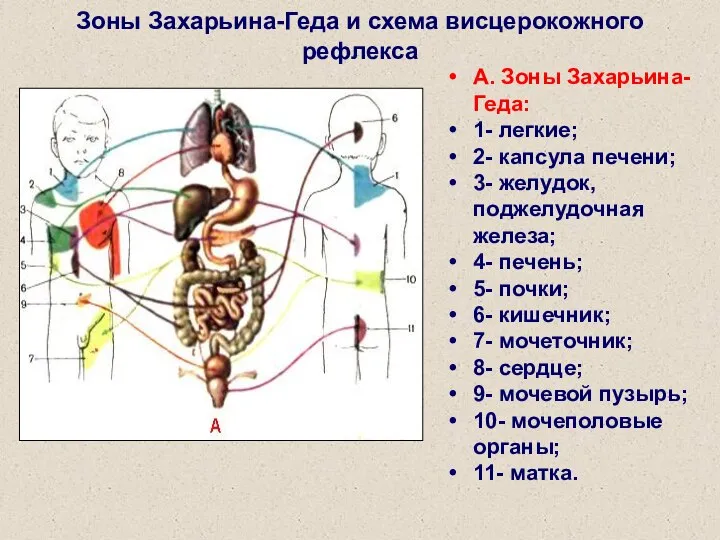 Зоны Захарьина-Геда и схема висцерокожного рефлекса А. Зоны Захарьина-Геда: 1- легкие; 2-