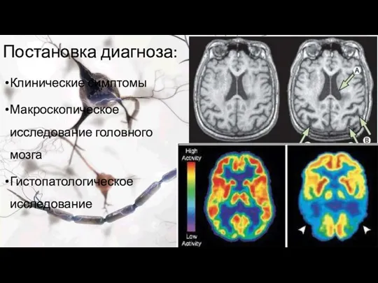 Постановка диагноза: Клинические симптомы Макроскопическое исследование головного мозга Гистопатологическое исследование
