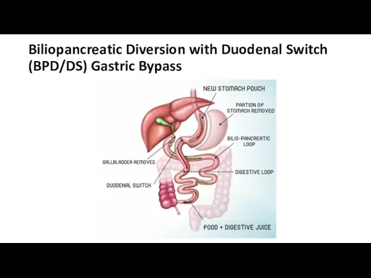 Biliopancreatic Diversion with Duodenal Switch (BPD/DS) Gastric Bypass