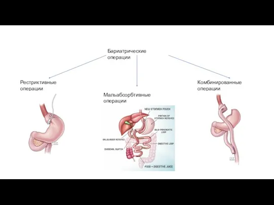 Бариатрические операции Рестриктивные операции Мальабсорбтивные операции Комбинированные операции