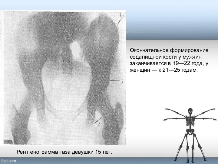 Рентгенограмма таза девушки 15 лет. Окончательное формирование седалищной кости у мужчин заканчивается
