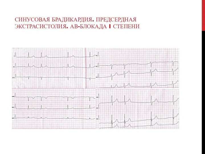 СИНУСОВАЯ БРАДИКАРДИЯ. ПРЕДСЕРДНАЯ ЭКСТРАСИСТОЛИЯ. АВ-БЛОКАДА I СТЕПЕНИ