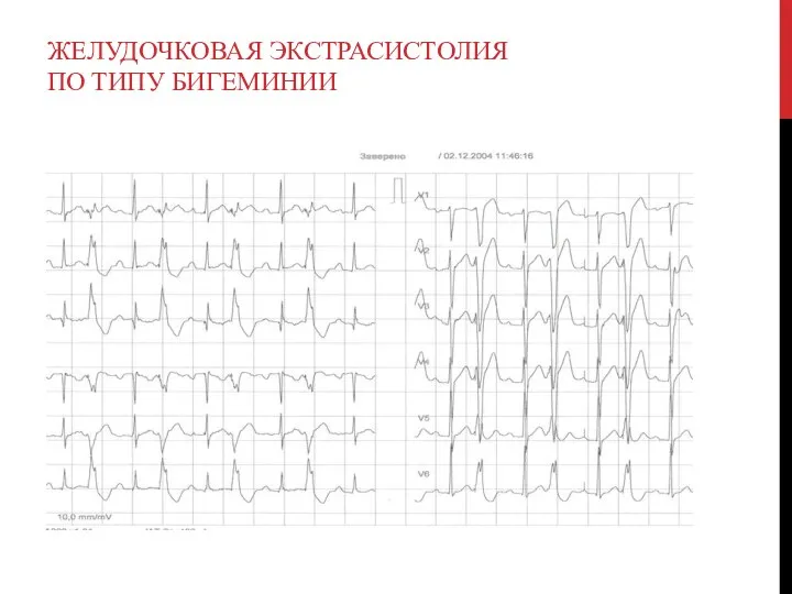 ЖЕЛУДОЧКОВАЯ ЭКСТРАСИСТОЛИЯ ПО ТИПУ БИГЕМИНИИ