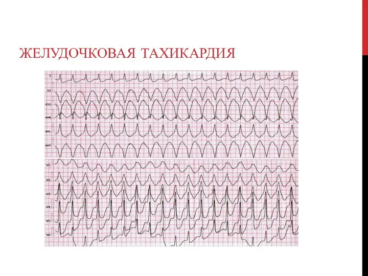 ЖЕЛУДОЧКОВАЯ ТАХИКАРДИЯ