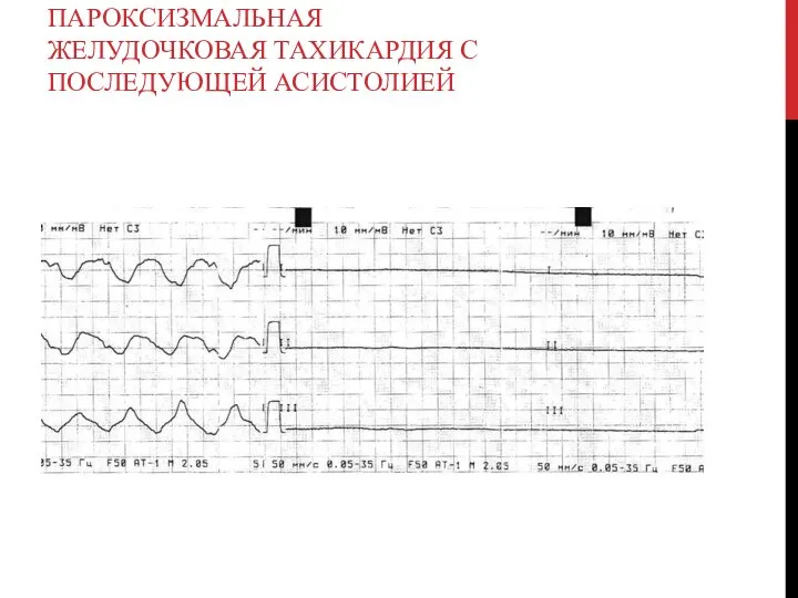 ПАРОКСИЗМАЛЬНАЯ ЖЕЛУДОЧКОВАЯ ТАХИКАРДИЯ С ПОСЛЕДУЮЩЕЙ АСИСТОЛИЕЙ