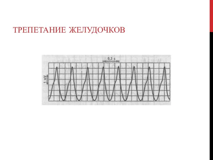 ТРЕПЕТАНИЕ ЖЕЛУДОЧКОВ