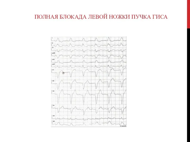 ПОЛНАЯ БЛОКАДА ЛЕВОЙ НОЖКИ ПУЧКА ГИСА