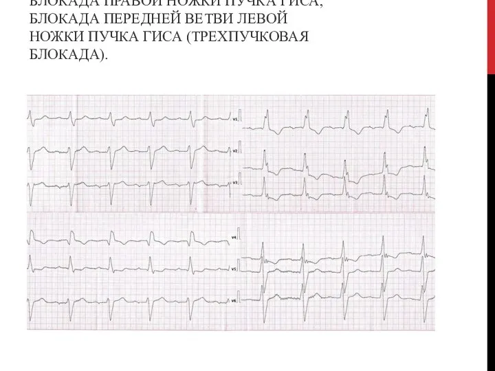 АВ-БЛОКАДА 1 СТЕПЕНИ, ПОЛНАЯ БЛОКАДА ПРАВОЙ НОЖКИ ПУЧКА ГИСА, БЛОКАДА ПЕРЕДНЕЙ ВЕТВИ