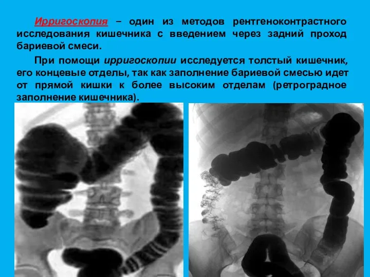 Ирригоскопия – один из методов рентгеноконтрастного исследования кишечника с введением через задний