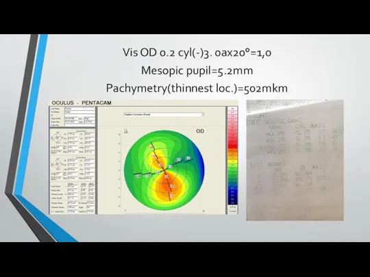 Vis OD 0.2 cyl(-)3. 0ax20°=1,0 Mesopic pupil=5.2mm Pachymetry(thinnest loc.)=502mkm