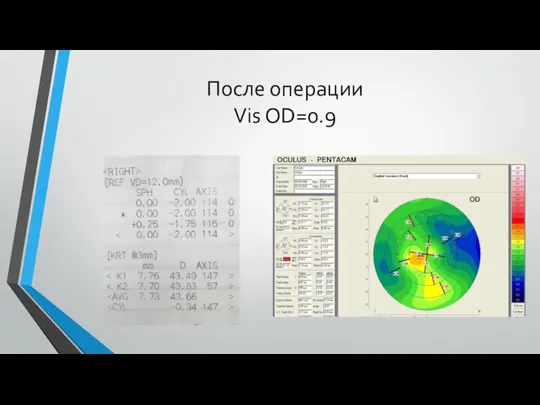 После операции Vis OD=0.9