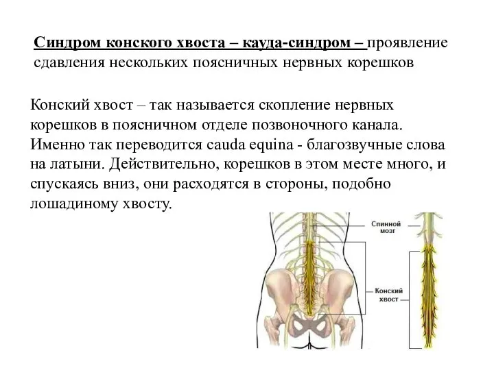 Синдром конского хвоста – кауда-синдром – проявление сдавления нескольких поясничных нервных корешков