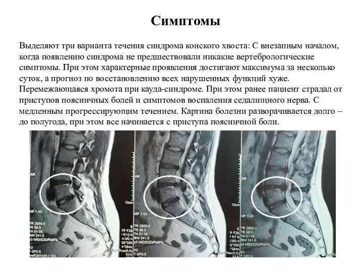 Симптомы Выделяют три варианта течения синдрома конского хвоста: С внезапным началом, когда