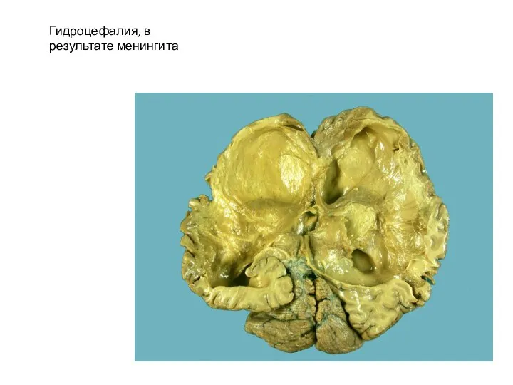 Гидроцефалия, в результате менингита