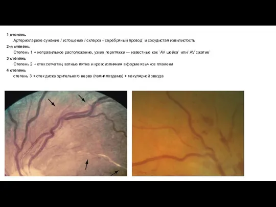 1 степень Артериоларное сужение / истощение / склероз -`серебряный провод` и сосудистая