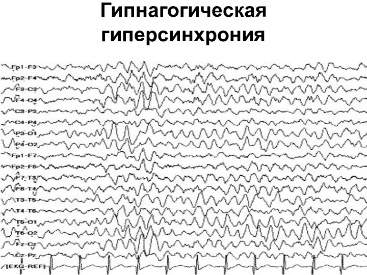 Гипнагогическая гиперсинхрония