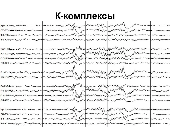 К-комплексы