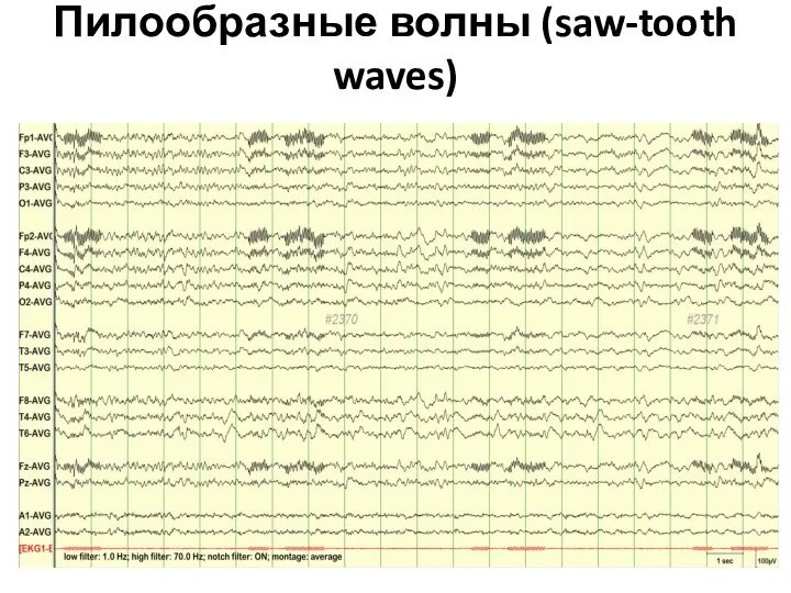 Пилообразные волны (saw-tooth waves)