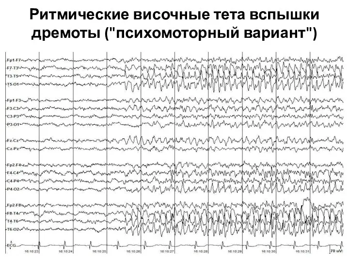 Ритмические височные тета вспышки дремоты ("психомоторный вариант")