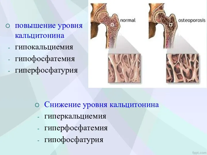 повышение уровня кальцитонина гипокальциемия гипофосфатемия гиперфосфатурия Снижение уровня кальцитонина гиперкальциемия гиперфосфатемия гипофосфатурия