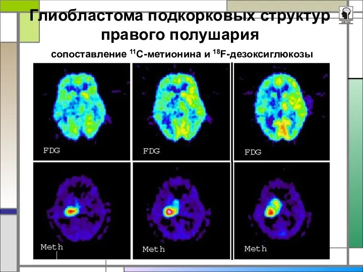 Глиобластома подкорковых структур правого полушария сопоставление 11С-метионина и 18F-дезоксиглюкозы