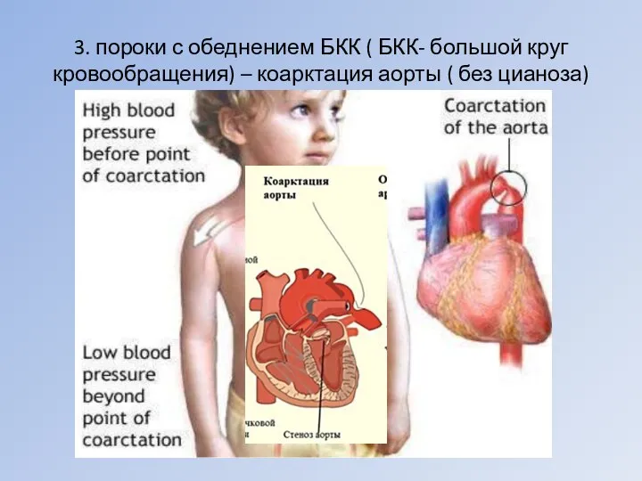 3. пороки с обеднением БКК ( БКК- большой круг кровообращения) – коарктация аорты ( без цианоза)