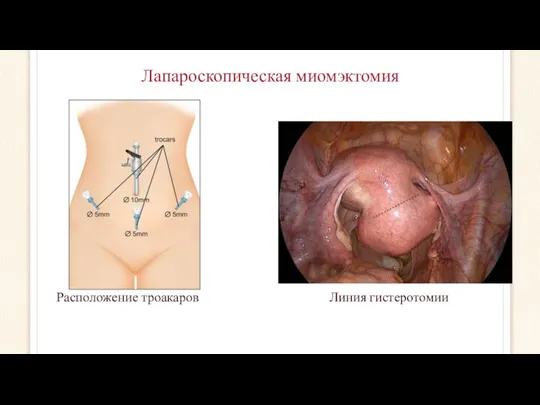 Расположение троакаров Линия гистеротомии Лапароскопическая миомэктомия