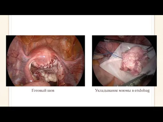 Готовый шов Укладывание миомы в endobag
