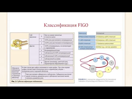 Классификация FIGO