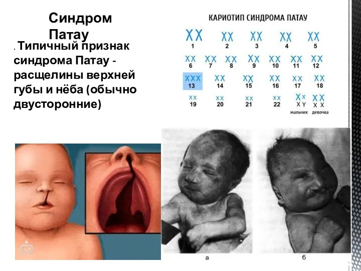 Синдром Патау . Типичный признак синдрома Патау - расщелины верхней губы и нёба (обычно двусторонние)