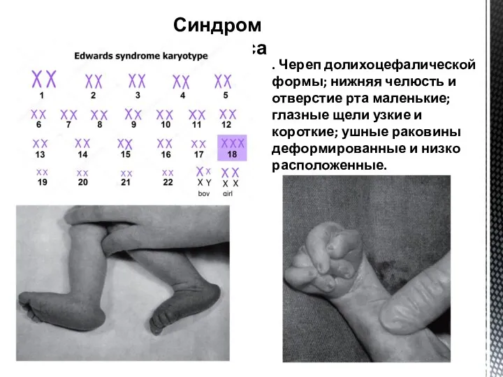 Синдром Эдвардса . Череп долихоцефалической формы; нижняя челюсть и отверстие рта маленькие;