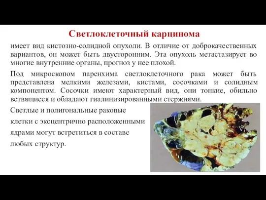 Светлоклеточный карцинома имеет вид кистозно-солидной опухоли. В отличие от доброкачественных вариантов, он