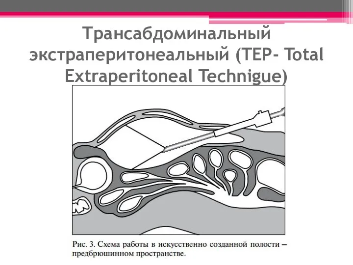 Трансабдоминальный экстраперитонеальный (TEP- Total Extraperitoneal Technigue)