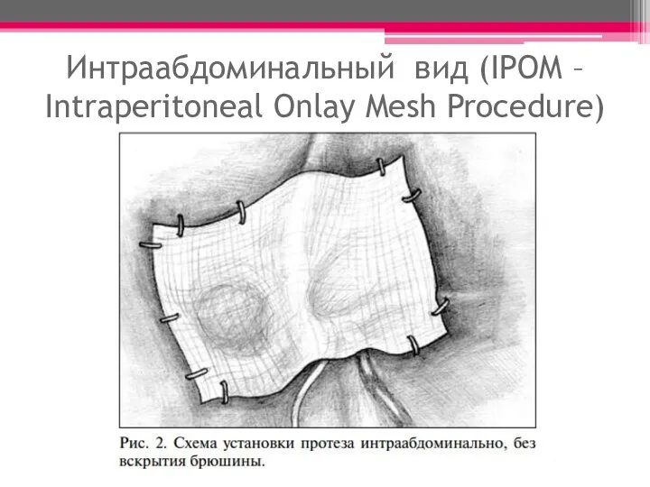 Интраабдоминальный вид (IPOM – Intraperitoneal Onlay Mesh Procedure)