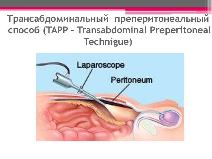 Трансабдоминальный преперитонеальный способ (TAPP – Transabdominal Preperitoneal Technigue)