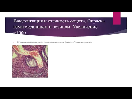 Вакуолизация и отечность ооцита. Окраска гематоксилином и эозином. Увеличение х1000 Дискомлексация фолликулярного