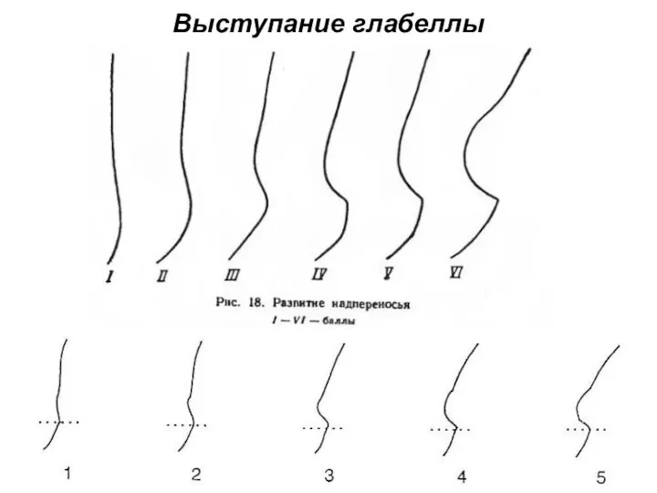 Выступание глабеллы