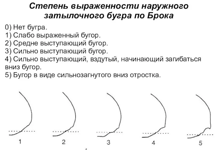 Степень выраженности наружного затылочного бугра по Брока 0) Нет бугра. 1) Слабо